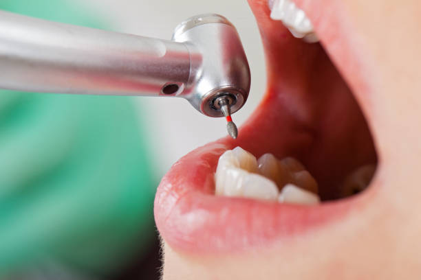 Best Emergency Tooth Extraction in Travis Ranch, TX